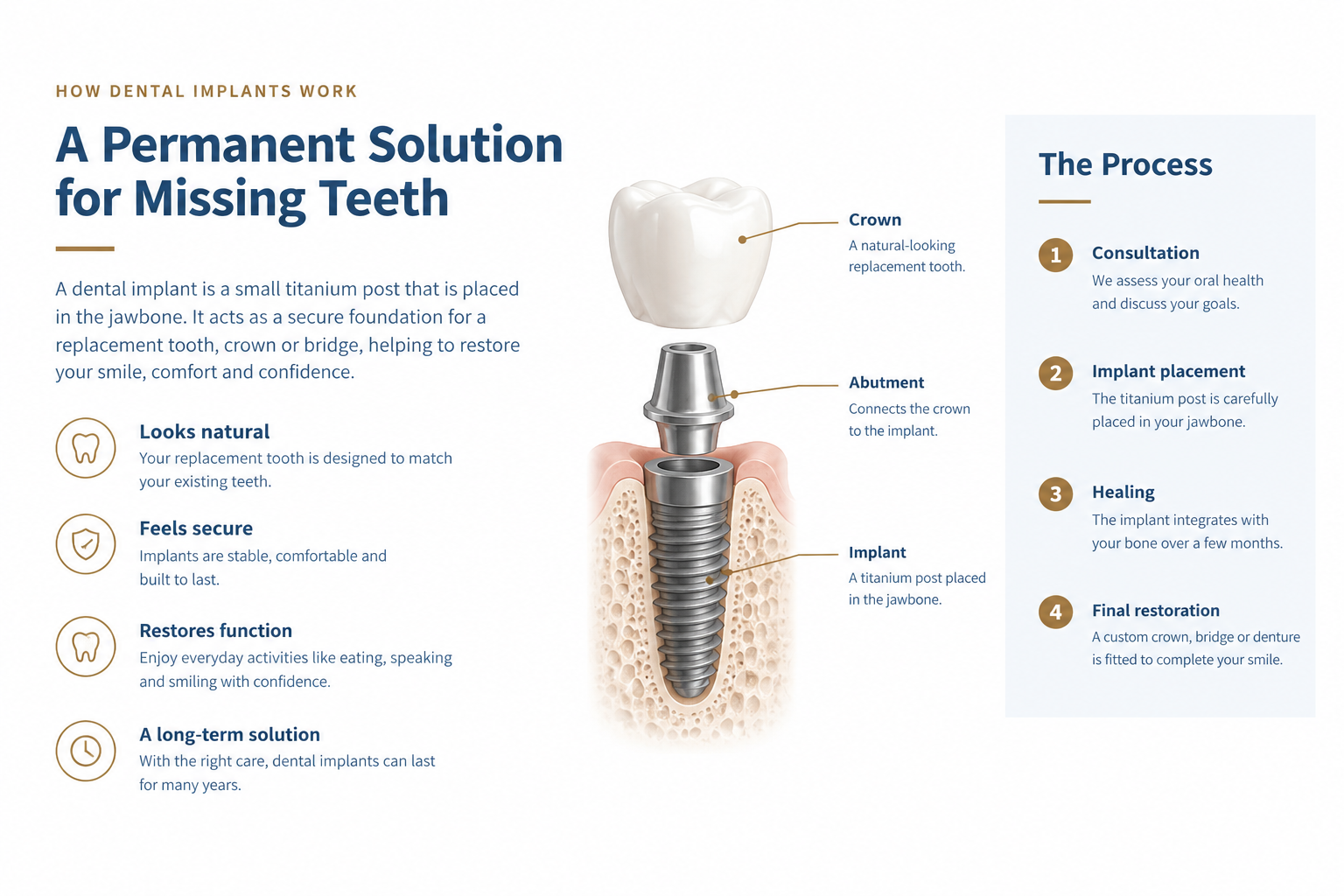 Dental implant infographic showing how an implant supports a replacement tooth and explaining the treatment stages