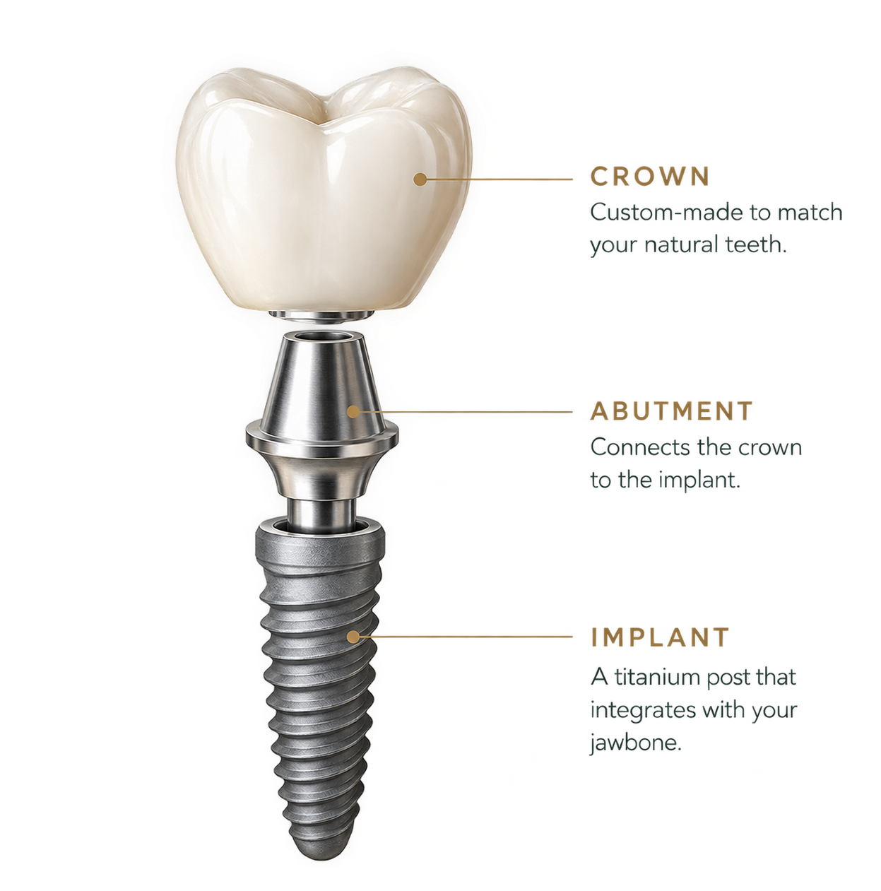 Exploded diagram showing the components of a dental implant, including the implant post, connector and replacement tooth