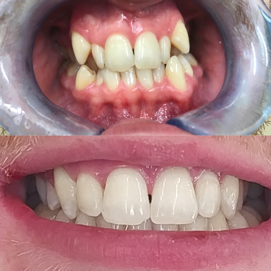 Braces treatment