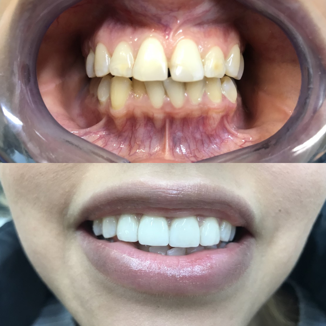 Smile makeover