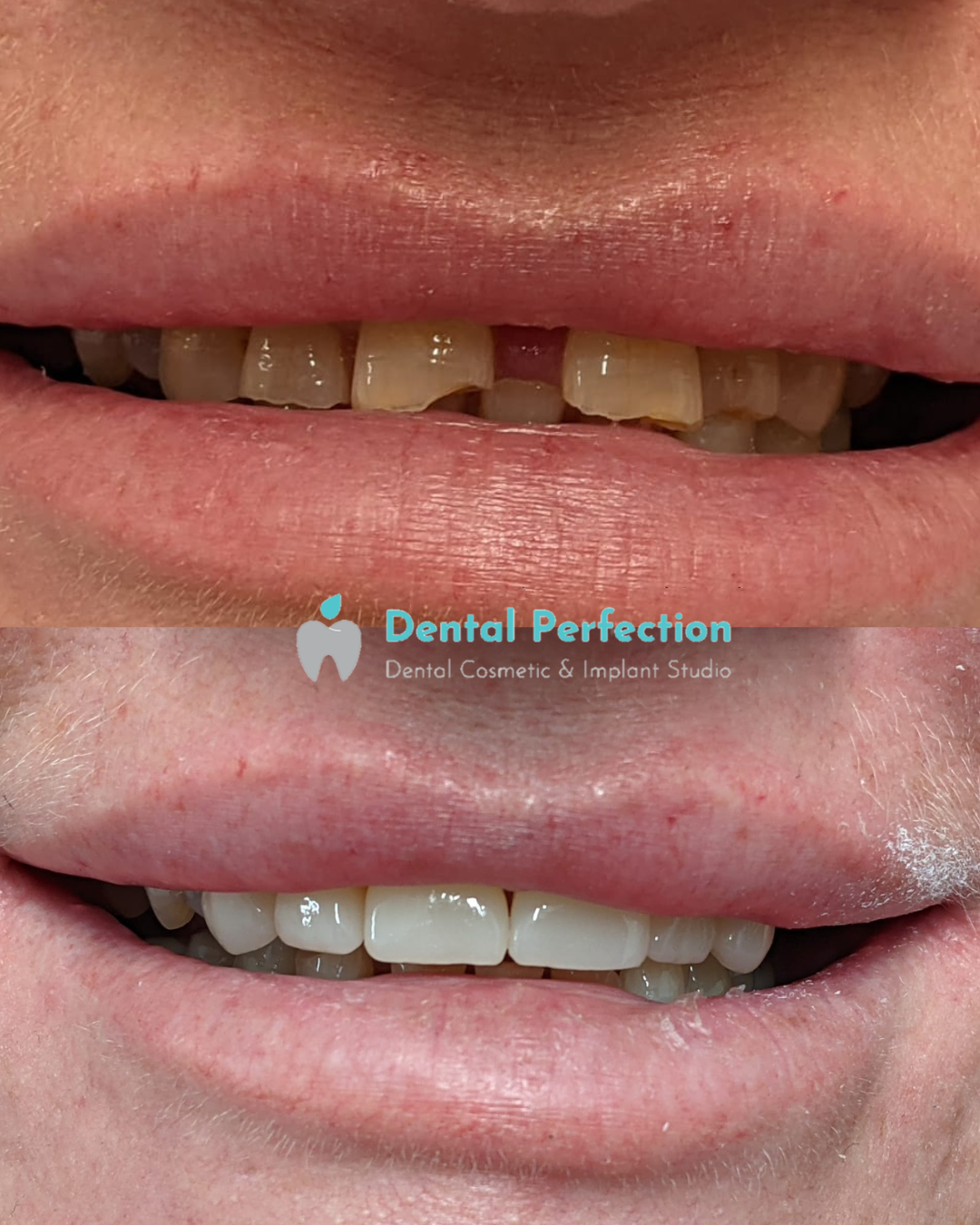 Dental crown makeover