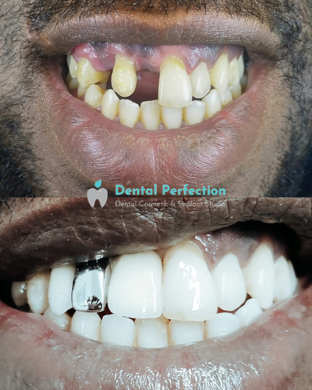 Smile transformation using implants and a silver tooth