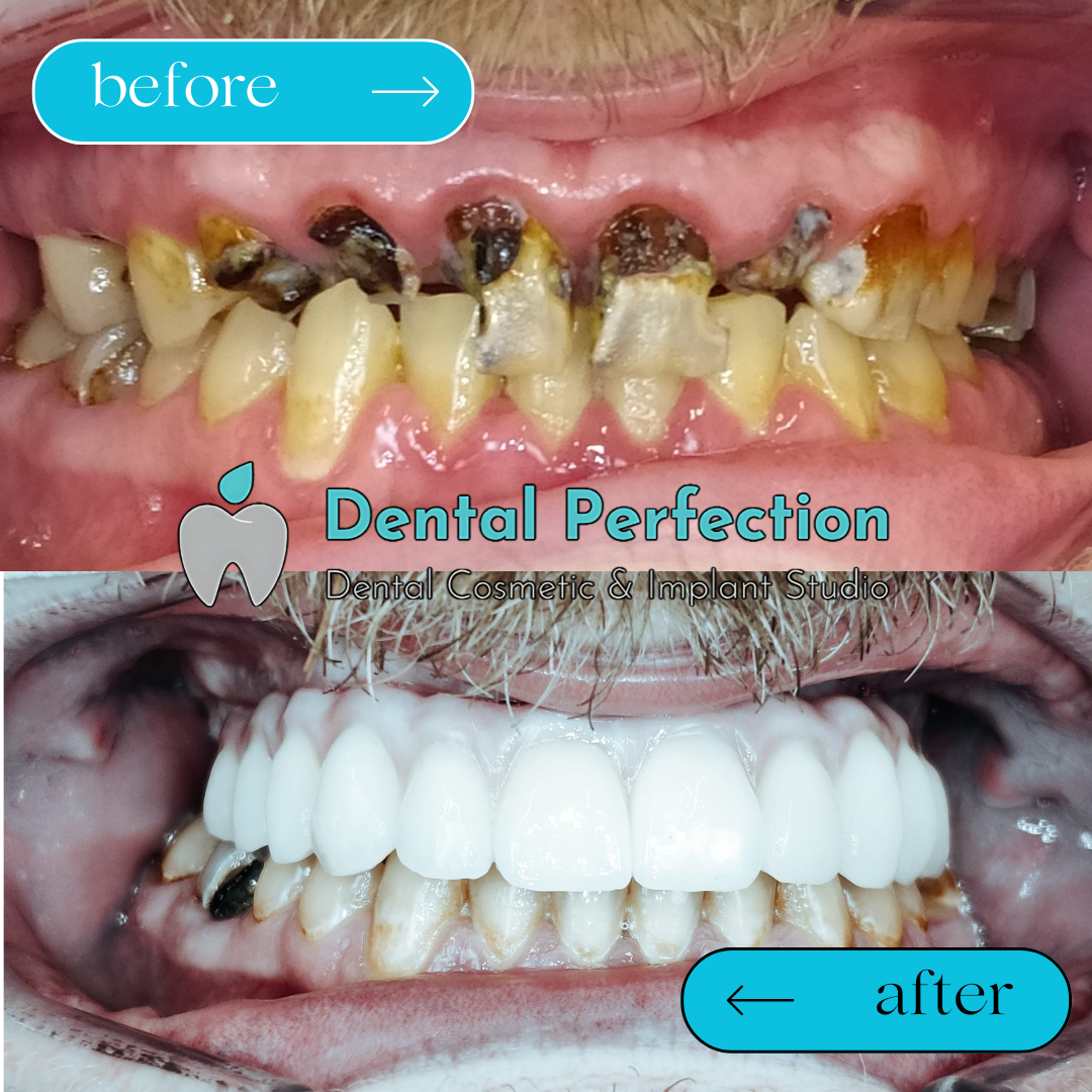 Full-arch tooth replacement treatment example