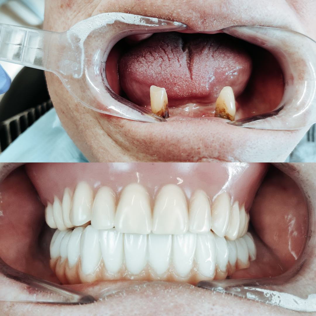 Implants and dentures treatment example