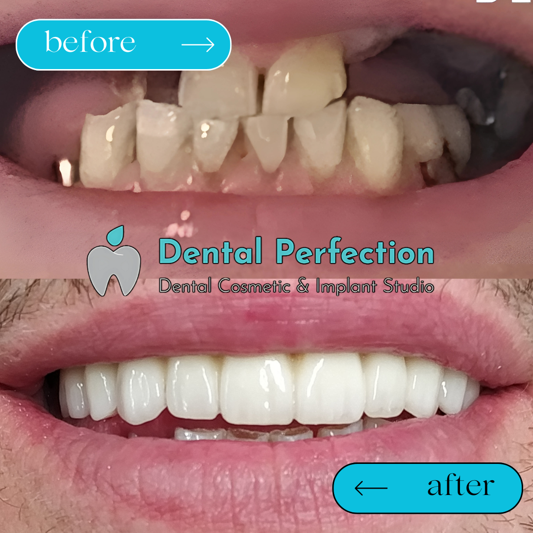 Full-arch implant treatment example