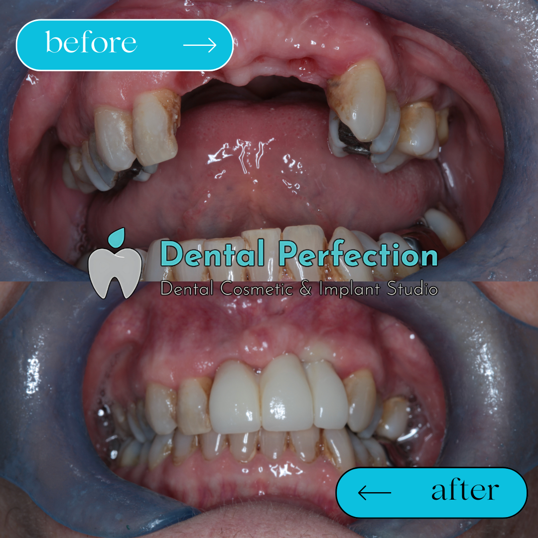 Implant-supported bridge treatment example