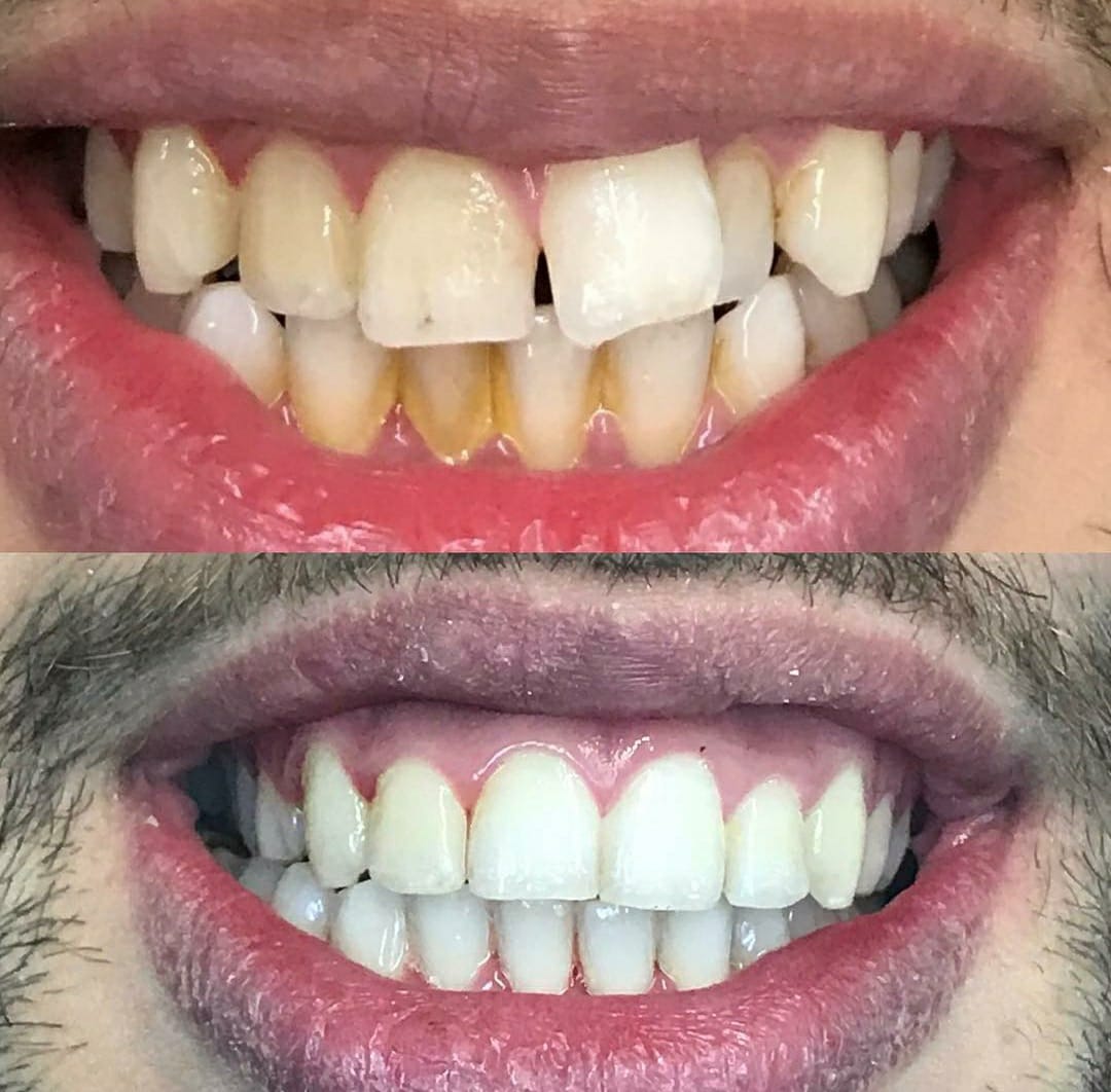Before and after dental transformation 1