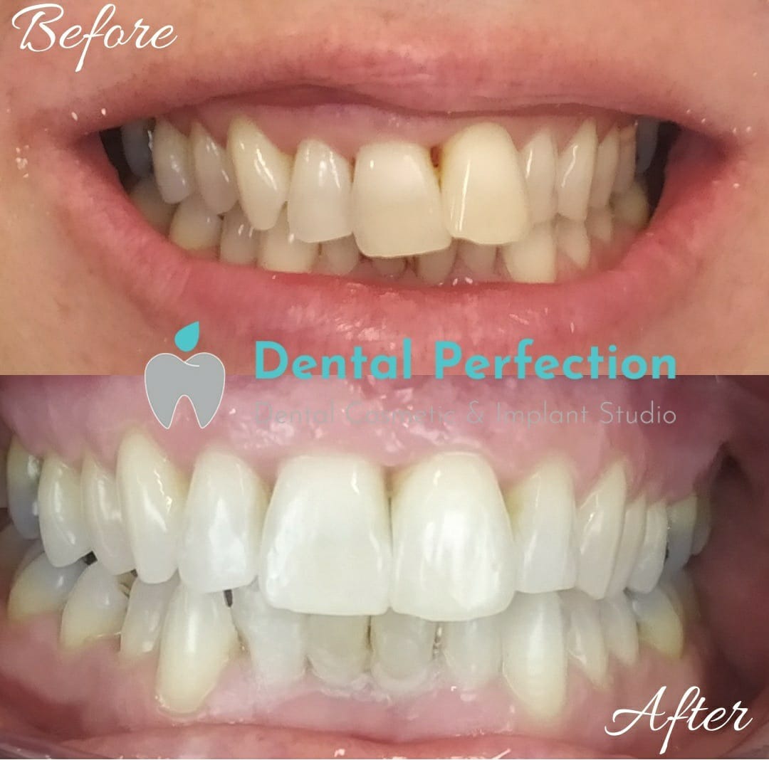 Before and after dental transformation 6