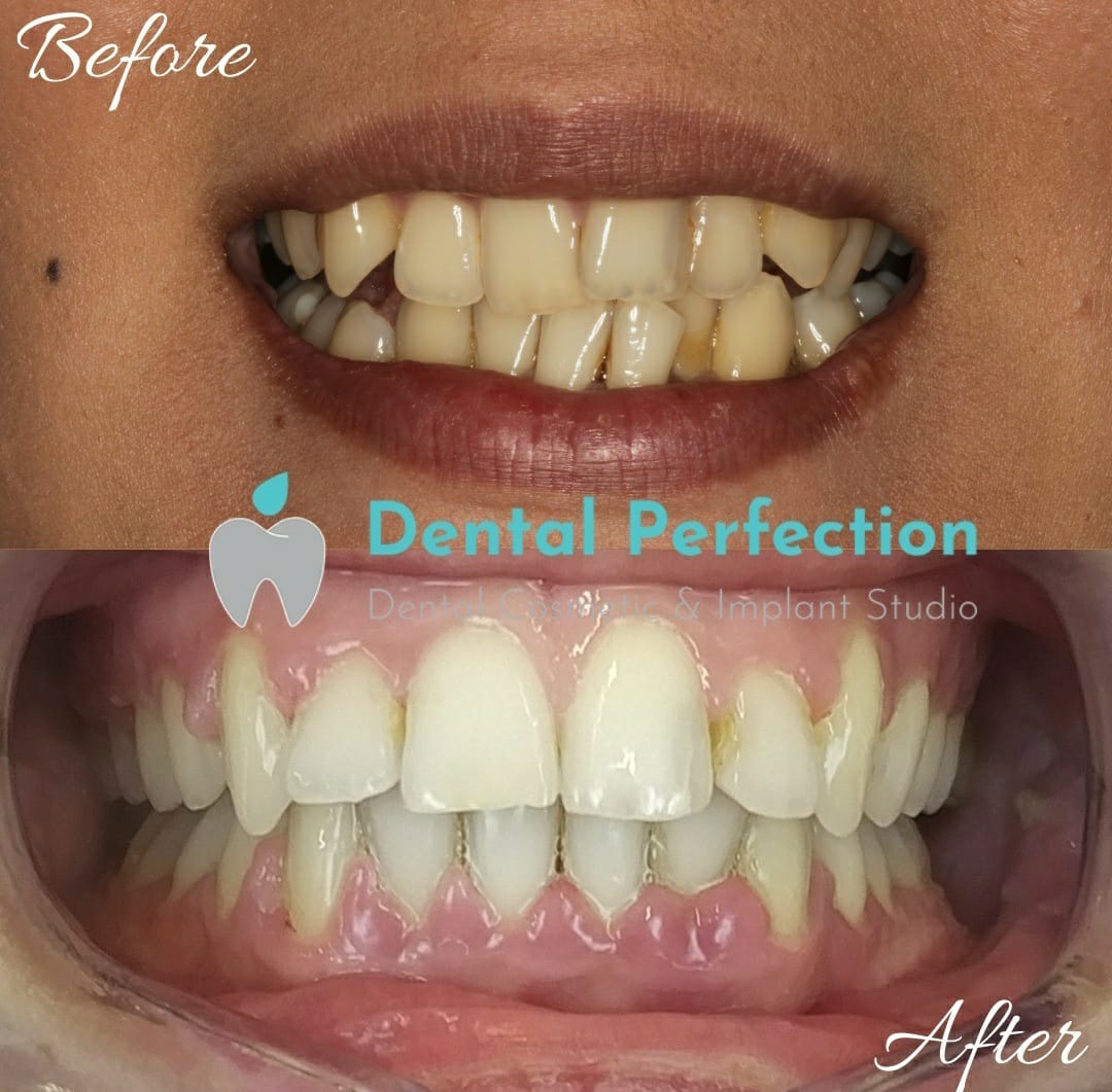 Before and after dental transformation 7