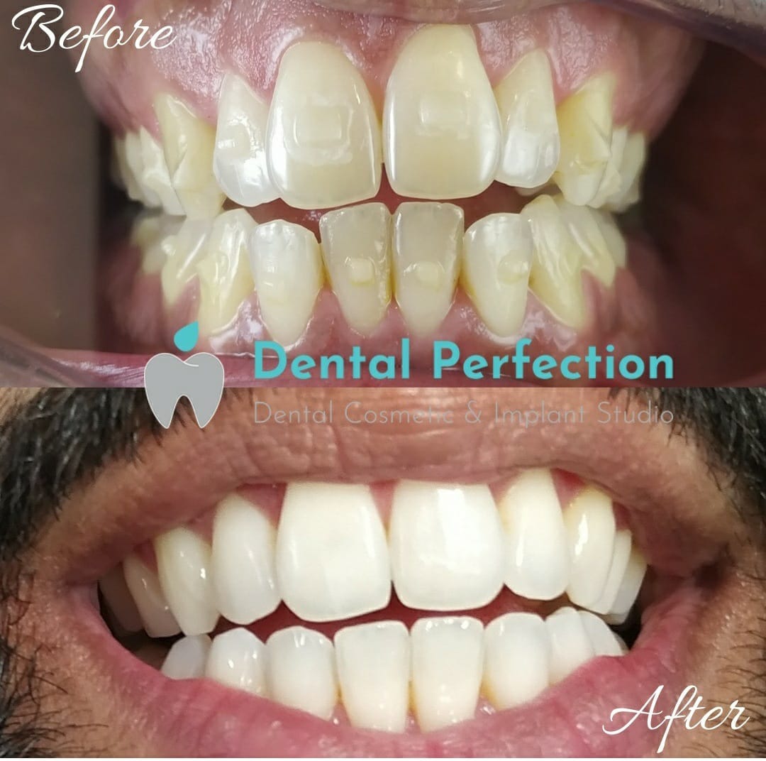 Before and after dental transformation 5