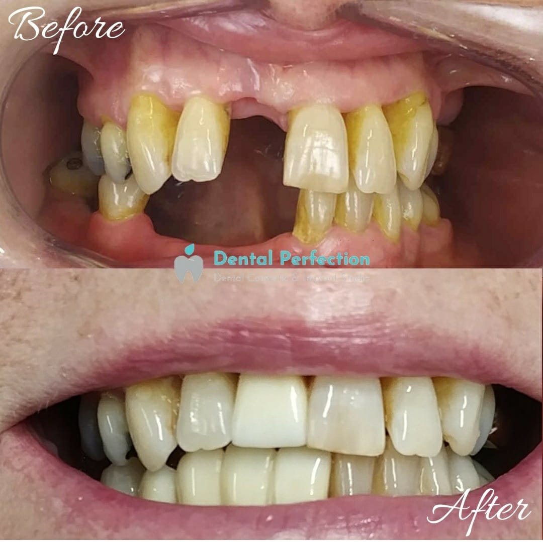 Before-and-after example of multiple dental implants