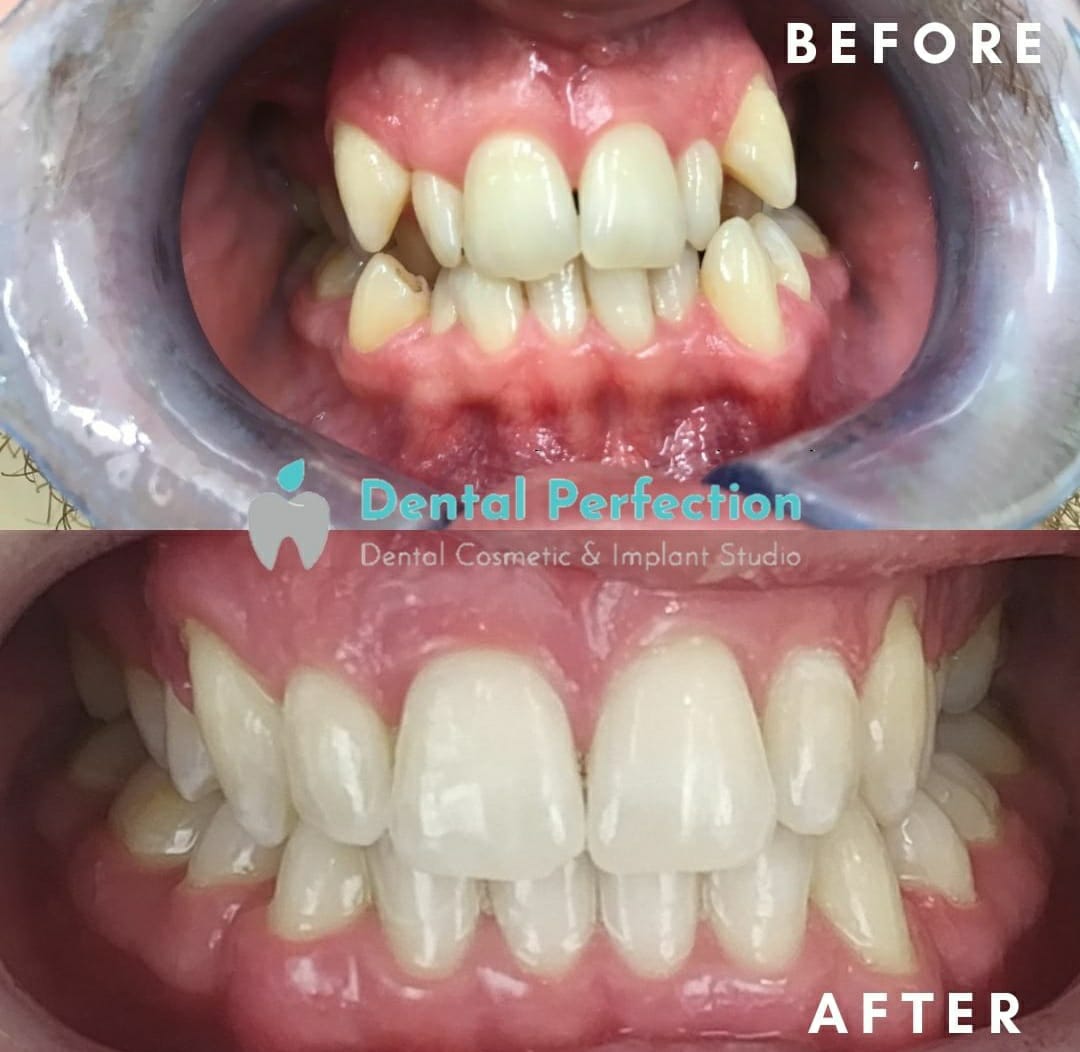 Before and after dental transformation 3
