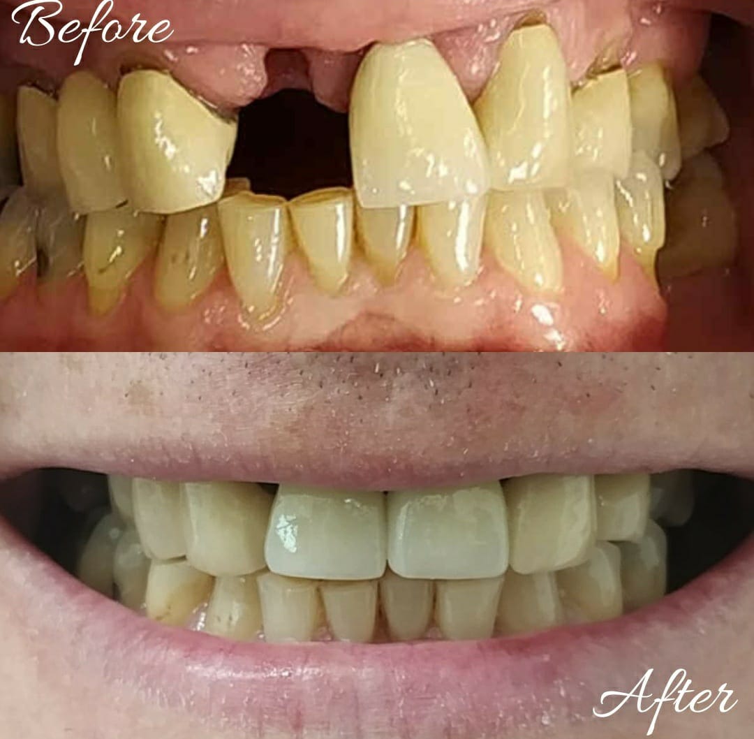 Before and after dental transformation 4