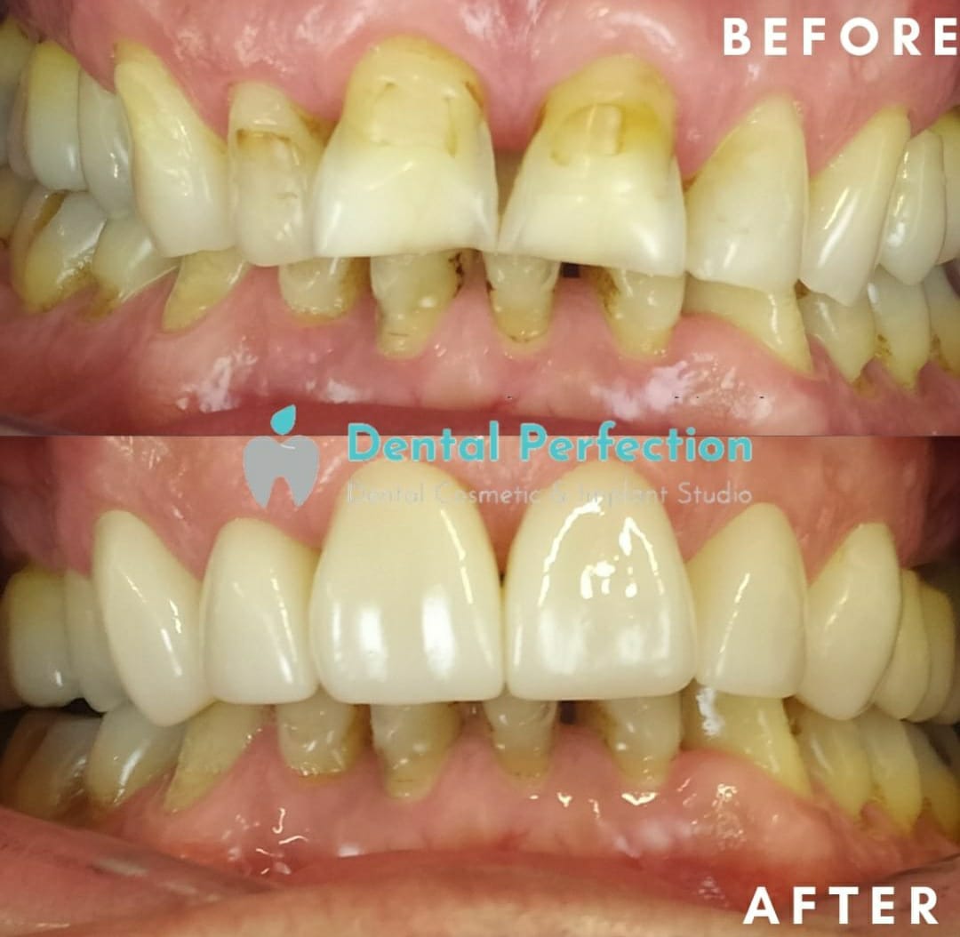 Before and after dental transformation 2
