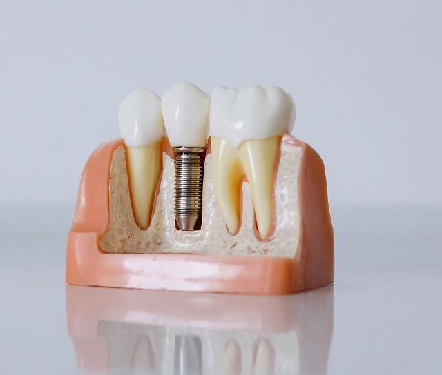 Single dental implant and replacement crown