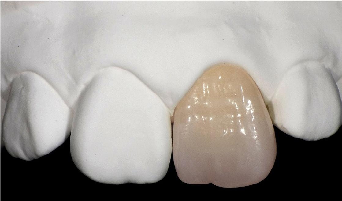 Dental implant treatment beside natural teeth