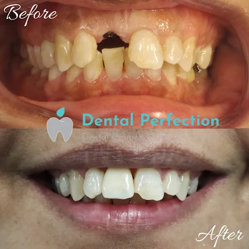 Single dental implant